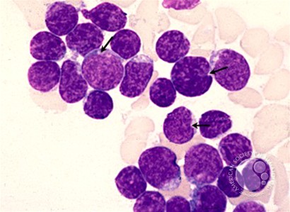Precursor T-lymphoblastic Leukemia - 2.
