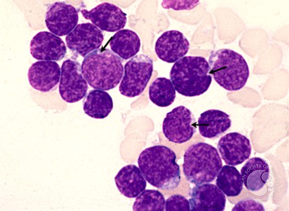 Precursor T-lymphoblastic Leukemia - 2.