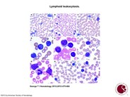 Lymphoid leukocytosis