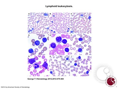 Lymphoid leukocytosis