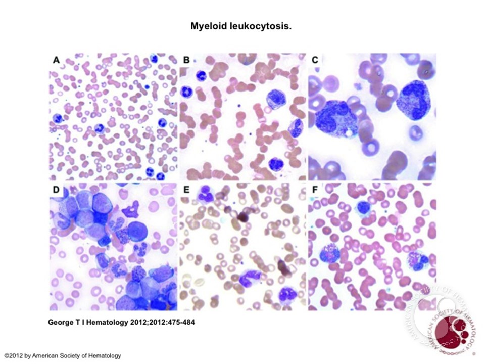 Myeloid leukocytosis