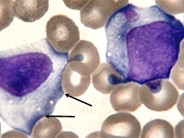 Infectious Mononucleosis - 1.