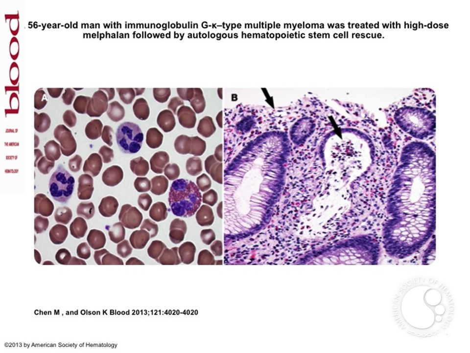 Colonic graft-versus-host disease (GVHD) manifesting as eosinophilic colitis following autologous hematopoietic stem cell transplantation
