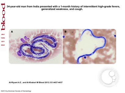 Concomitant microfilaria and malaria infection
