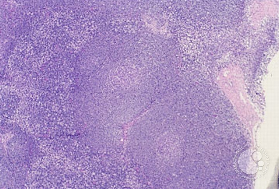 Mantle Cell Lymphoma - 1.