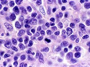 Mantle Cell Lymphoma - 10.