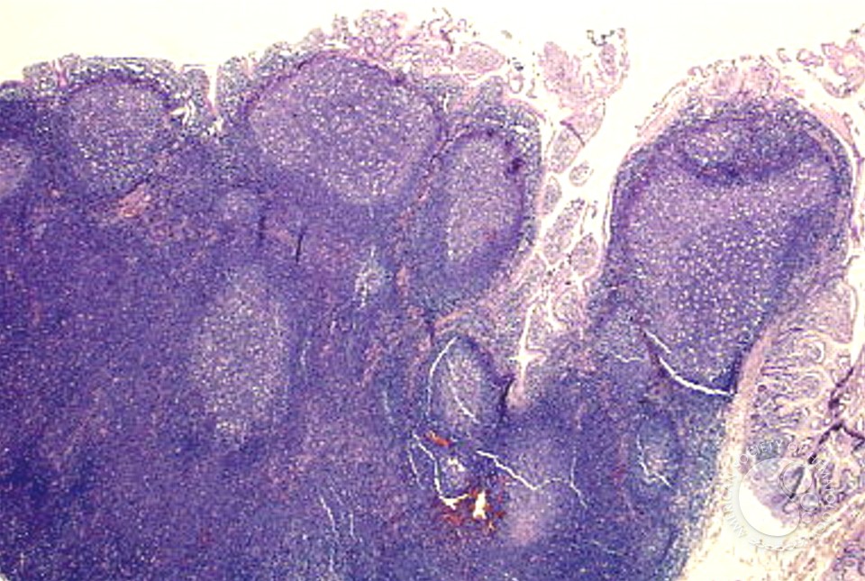 Mantle Cell Lymphoma - 11.