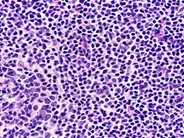 Mantle Cell Lymphoma - 5.