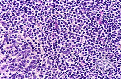 Mantle Cell Lymphoma - 5.