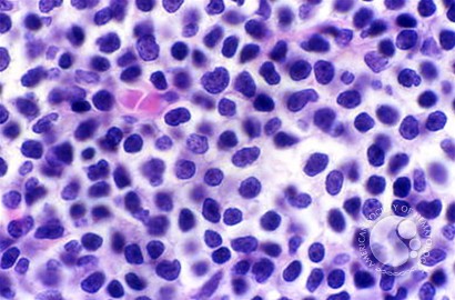 Mantle Cell Lymphoma - 6.
