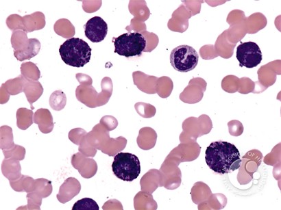 Acute Basophilic Leukemia - 1.