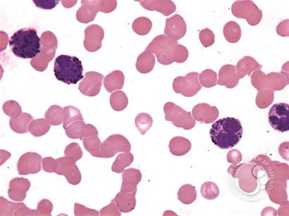 Acute Basophilic Leukemia - 2.