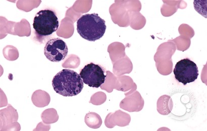 Acute Basophilic Leukemia - 3.