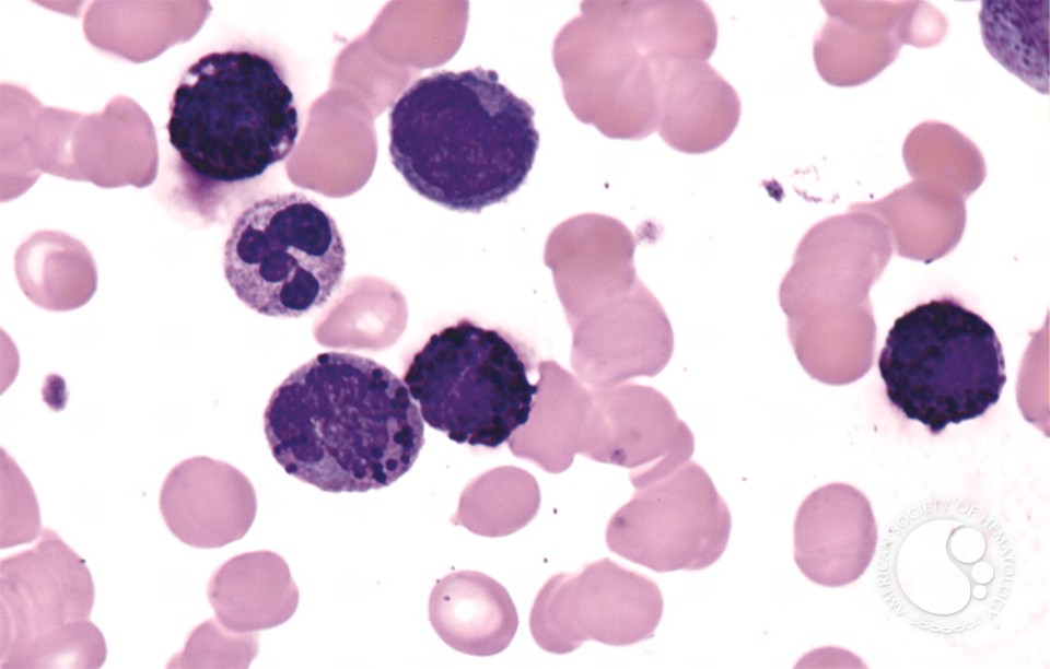 Acute Basophilic Leukemia - 3.