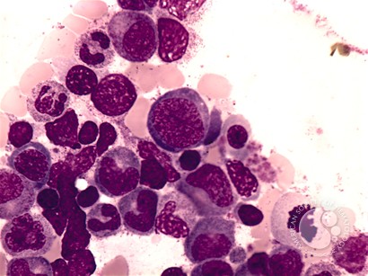 Megaloblastic Anemia - 2.