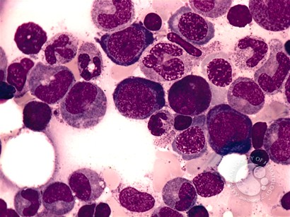 Megaloblastic Anemia - 3.