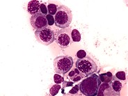 Megaloblastic Anemia - 4.
