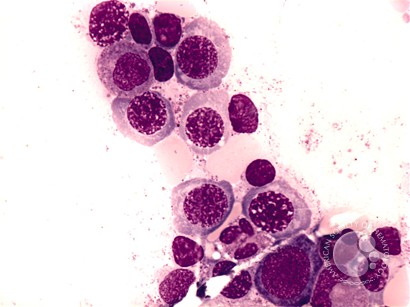 Megaloblastic Anemia - 4.