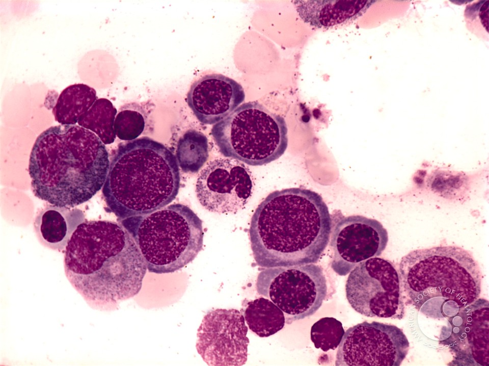 Megaloblastic Anemia - 5.