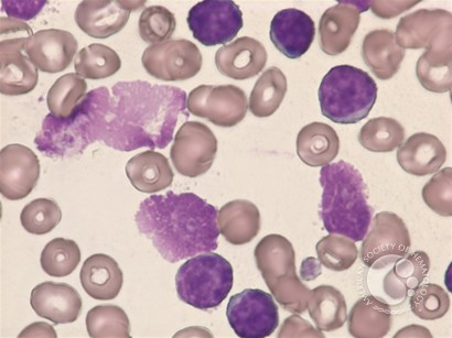CLL - mixed cell type