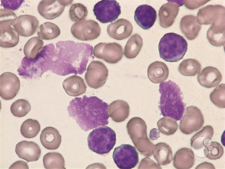 CLL - mixed cell type