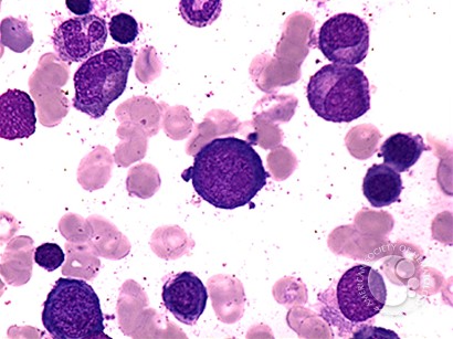 Megaloblastic Anemia - 6.