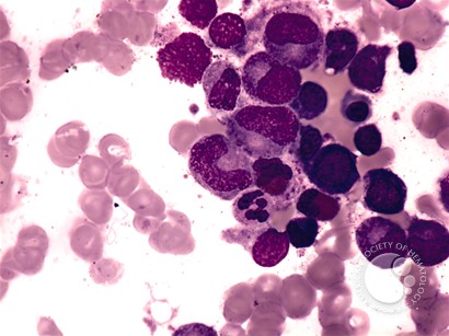 Megaloblastic Anemia - 7.