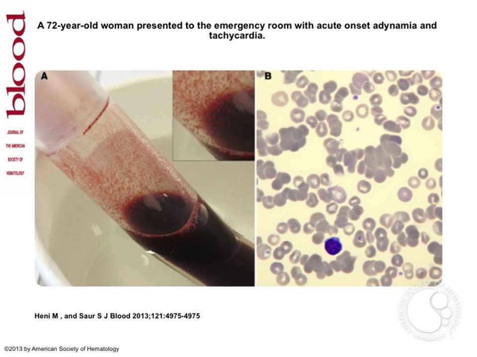 Blood clotting at room temperature in cold agglutinin disease