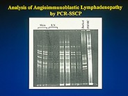 Angioimmunoblastic T Cell Lymphoma - 1.