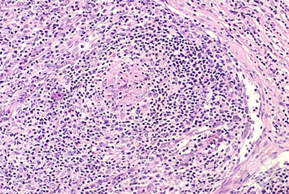 Angioimmunoblastic T Cell Lymphoma - 10.