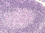 Angioimmunoblastic T Cell Lymphoma - 11.