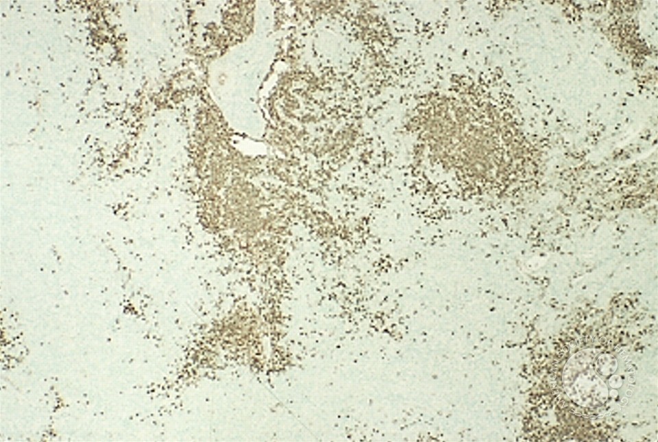 Angioimmunoblastic T Cell Lymphoma - 13.