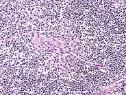 Angioimmunoblastic T Cell Lymphoma - 14.