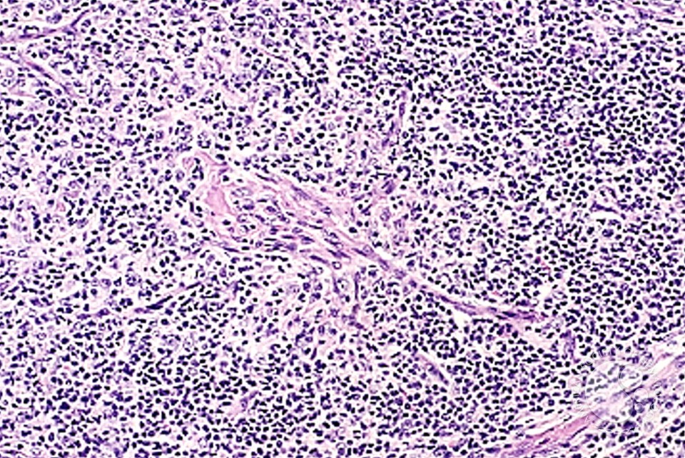Angioimmunoblastic T Cell Lymphoma - 14.