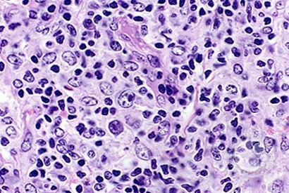 Angioimmunoblastic T Cell Lymphoma - 15.
