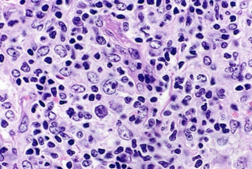 Angioimmunoblastic T Cell Lymphoma - 15.