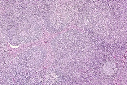 Angioimmunoblastic T Cell Lymphoma - 3.