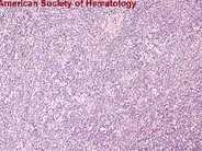 Angioimmunoblastic T Cell Lymphoma - 4.