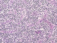 Angioimmunoblastic T Cell Lymphoma 5.