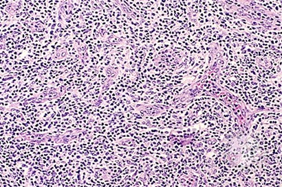 Angioimmunoblastic T Cell Lymphoma - 5.