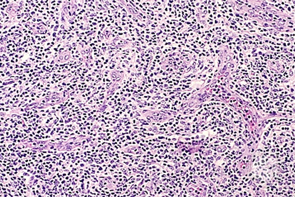 Angioimmunoblastic T Cell Lymphoma - 5.