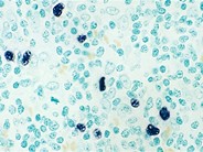 Angioimmunoblastic T Cell Lymphoma - 6.