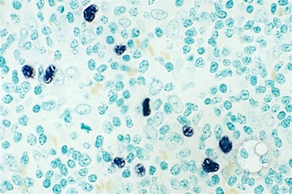 Angioimmunoblastic T Cell Lymphoma - 6.