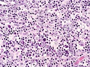 Angioimmunoblastic t cell lymphoma