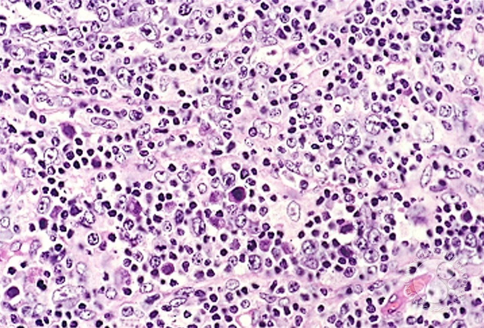 Angioimmunoblastic T Cell Lymphoma - 7.