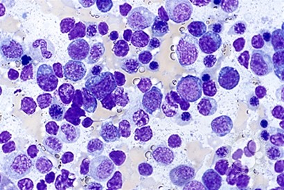Angioimmunoblastic T Cell Lymphoma - 8.