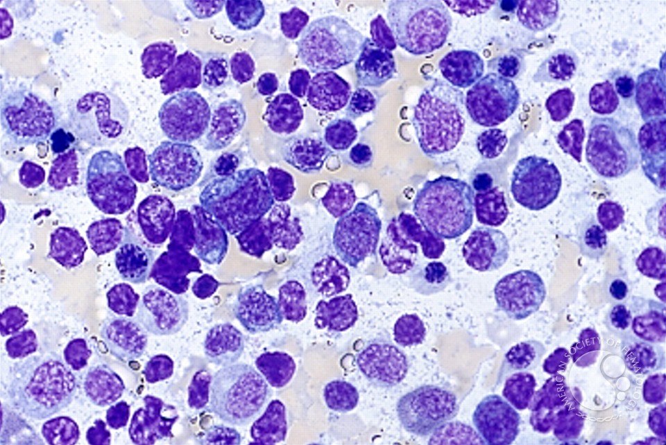 Angioimmunoblastic T Cell Lymphoma - 8.