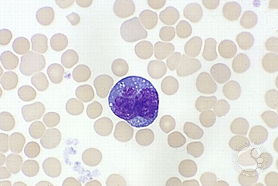 Angioimmunoblastic T Cell Lymphoma - 9.