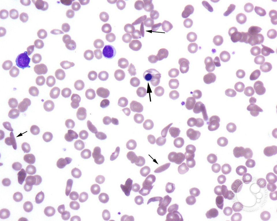 Aplastic Crisis in a Patient with Sickle Cell Disease - 1.