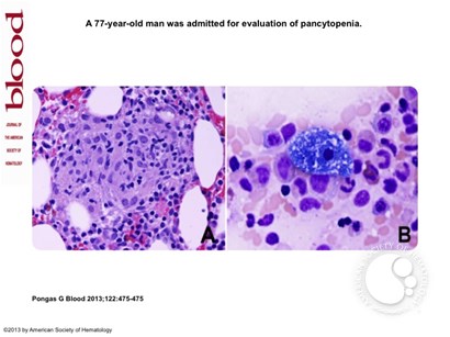 Sea-blue–colored histiocytes associated with bone marrow granulomas